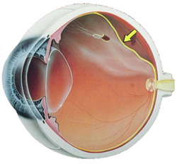 отслоение сетчатки глаза лечение