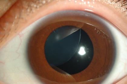 Заболевания глаз и методы лечения