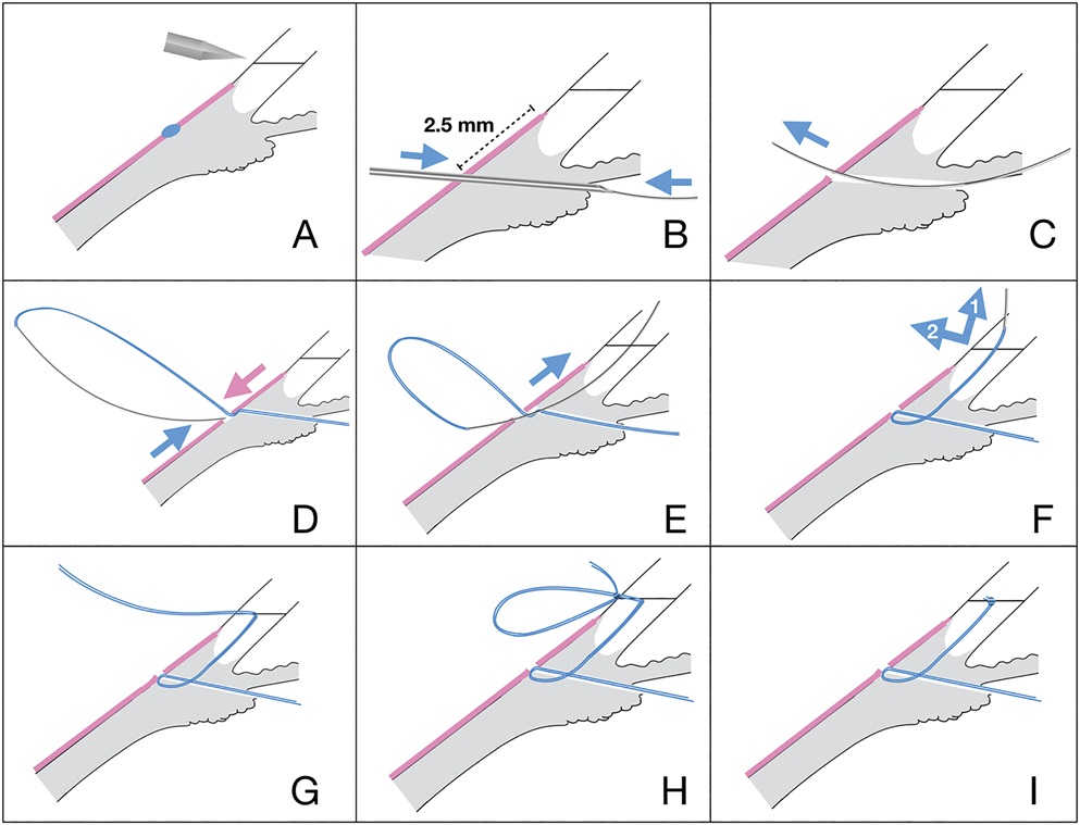  fixation of intraocular lenses Kojuhov Arseniy