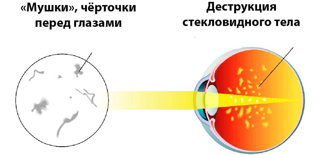 Почему в глазах мушки появляются черные и ниточки: причины и советы