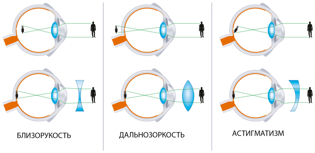 дальнозоркость близорукость астигматизм коррекция