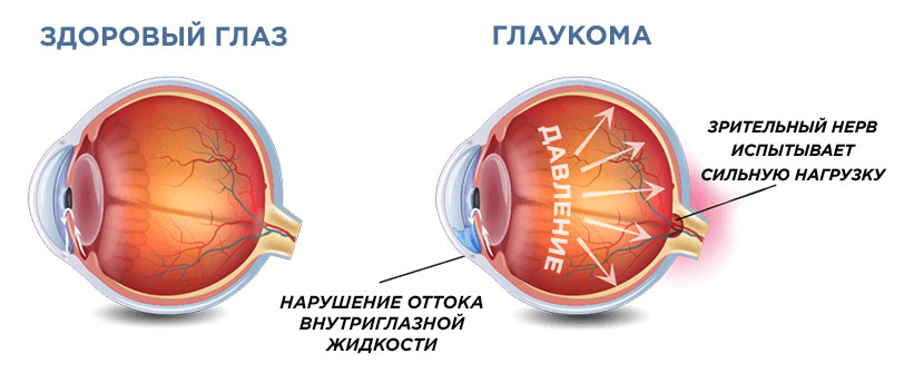 Глаукома глаз