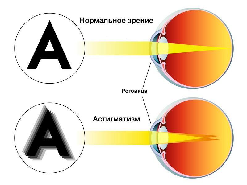 Астигматизм