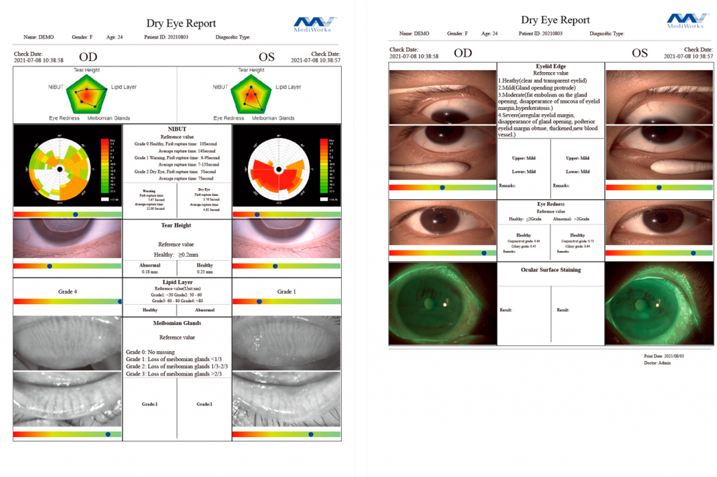 синдром сухого глаза диагностика и лечение