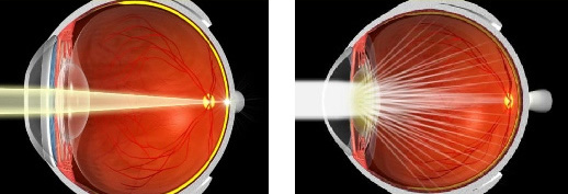 операция по удалению катаракты: схема рассеивания света в глазу