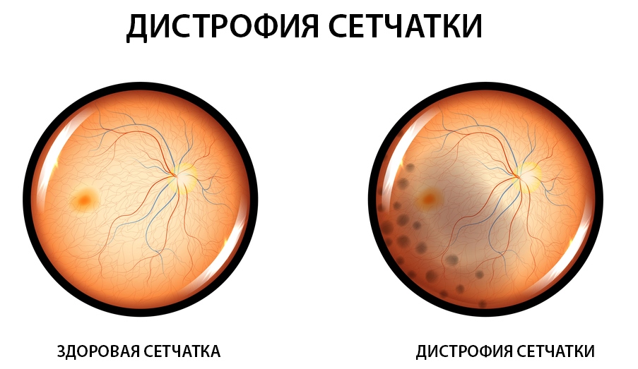 Дистрофия сетчатки глаза