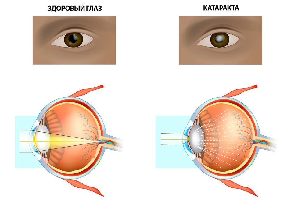 зрение при катаракте