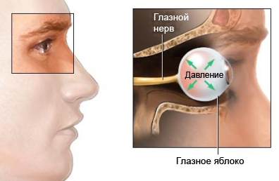 глаукоме открытоугольной лечение 