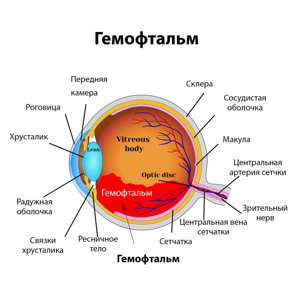 Гемофтальм Гемофтальм