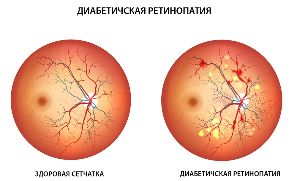 Диабетическая ритопатия лечение