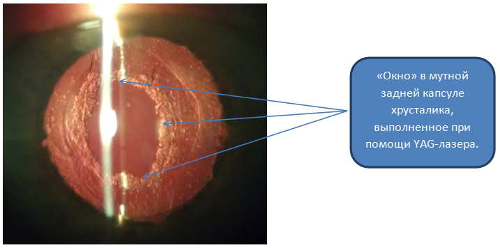Вторичная катаракта после операции. Лазерная дисцизия задней капсулы хрусталика. Вторичная катаракта лазерная дисцизия. Вторичная катаракта фиброз задней капсулы. Вторичная катаракта помутнение задней капсулы.