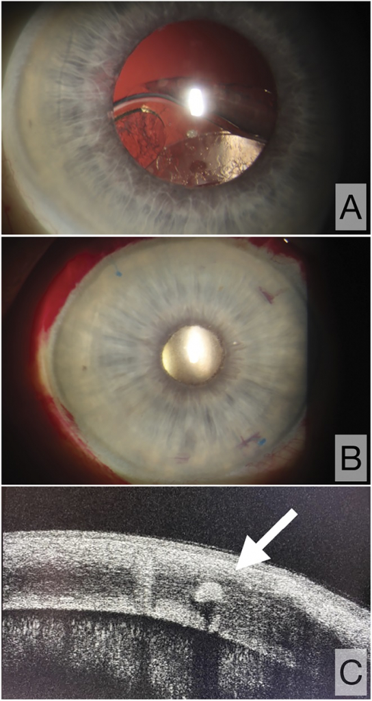  fixation of intraocular lenses Kojuhov Arseniy
