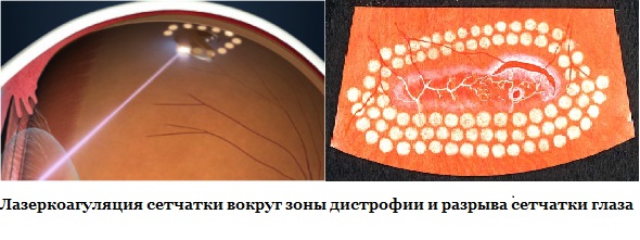 Периферическая дистрофия сетчатки Лазерная коагуляция сетчатки