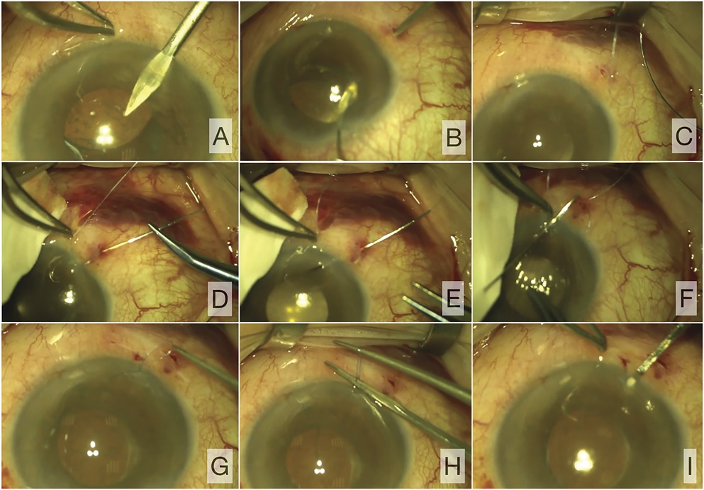 fixation of intraocular lenses Kojuhov Arseniy fixation of intraocular lenses Kojuhov Arseniy