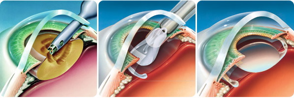 Операция по замене хрусталика глаза