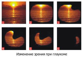 glaukoma.jpg Зрение при глаукоме